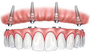 fixed-in implant-supported dentures in spring branch tx