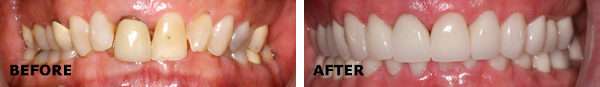 full mouth rehabilitation in spring branch