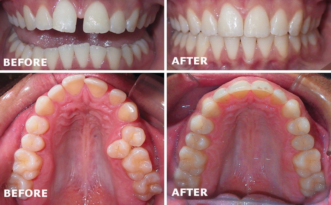 Invisalign® Teeth Straightening Spring Branch Dental Care